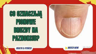 Co oznaczają pionowe bruzdy na paznokciach? Zdrowie i przyczyny