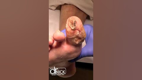 When infection invades bone. 😳