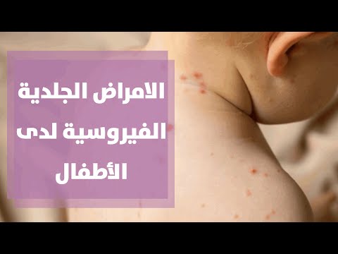 الامراض الجلدية الفيروسية لدى الأطفال