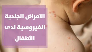 الامراض الجلدية الفيروسية لدى الأطفال