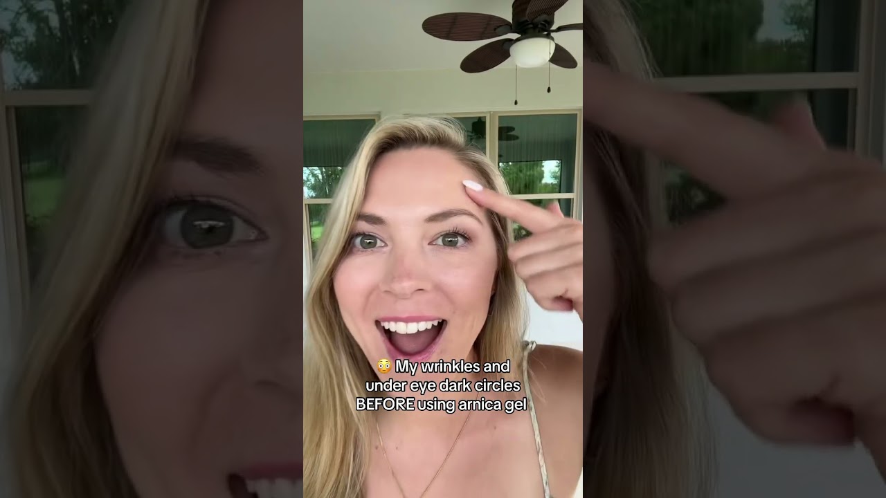 Wrinkles and under eye dark circles before and after arnica gel 