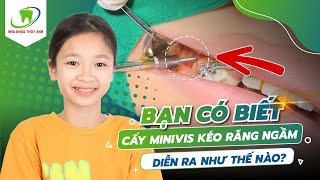 Niềng Răng Nên Xem - Chi Tiết Quá Trình Cấy Minivis