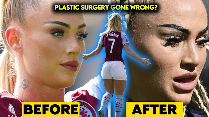 What The Hell HAPPENED to Alisha Lehmann's Face??