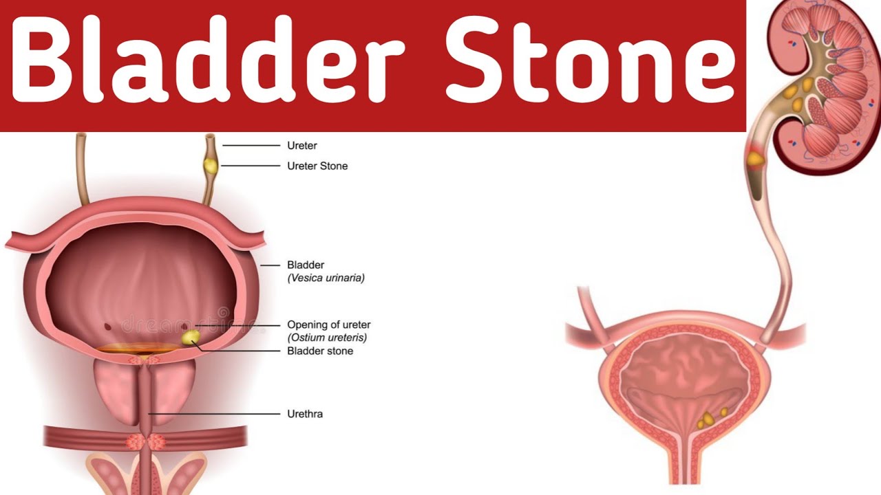 Bladder Stone - Bladder stone symptoms, Causes, Complications ...