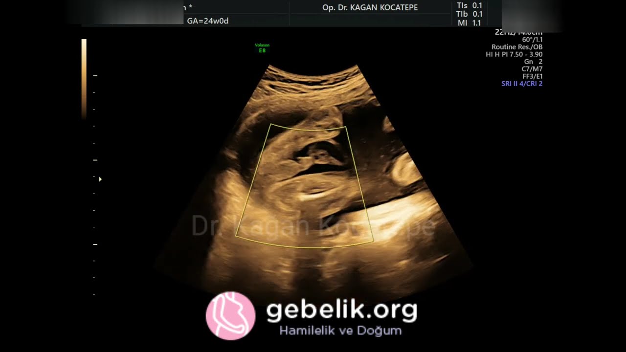 Erkek bebek ultrason görüntüleri, bacak arasından cinsel organı net