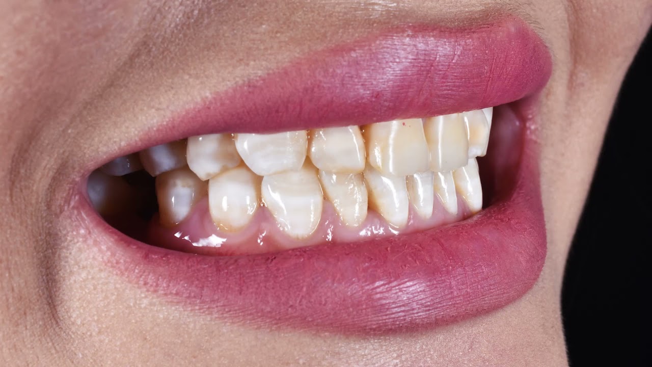 Виниринг| Лечение флюроза|Шымкент - YouTube