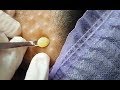 角栓  - ニキビ 角栓 – Cystic Acne Extraction Close Up | Blackheads