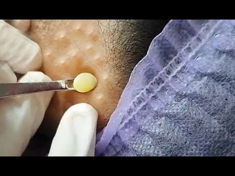 角栓 ニキビ 角栓 Cystic Acne Extraction Close Up Blackheads Youtube