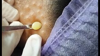 角栓  - ニキビ 角栓 – Cystic Acne Extraction Close Up | Blackheads