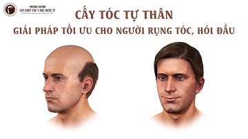 Giải đáp tất tần tật các câu hỏi về cấy tóc tự thân và các kĩ thuật cấy tóc hiện đại nhất hiện nay
