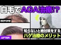 【薄毛治療】ラファエルさんも絶賛の自毛植毛とは!?植毛手術・AGA治療を徹底解説【湘南美容クリニック】