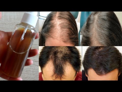 The ultimate solution for hair loss, dandruff treatment.  It gives a brown color to the hair.