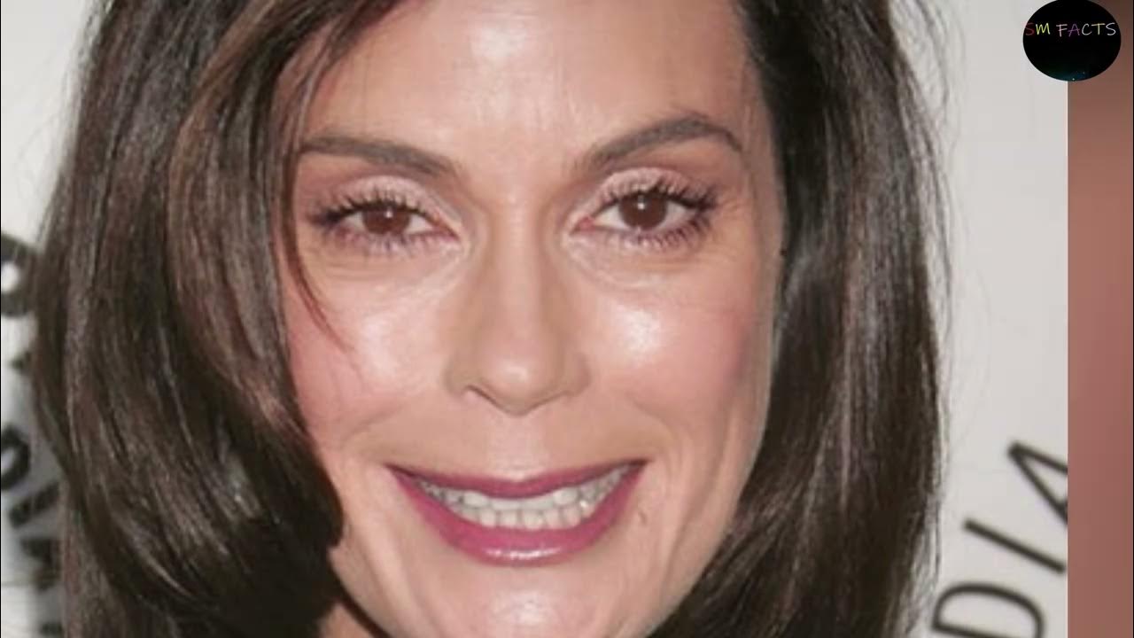 Facelift (Female, 62) Dr. Gregory A. Greco