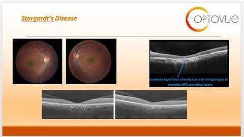 OCT Interpretation Session 7 Congenital Retinal Variations and Dystrophies