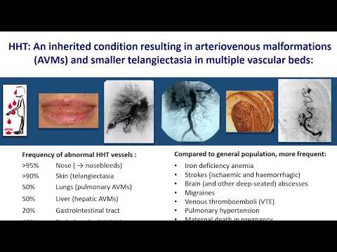 Video: Je, telangiectasia itaondoka?