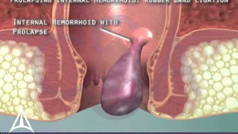 Rubber Band Ligation for Hemorrhoids - 3D Medical Animation - DayDayNews
