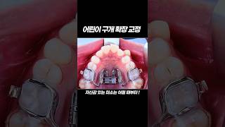 어린이 구개 확장 교정     #치과 #dentist #교정 #미소