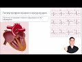 ЭКГ за 100 минут №6: Гипертрофия сердца на ЭКГ