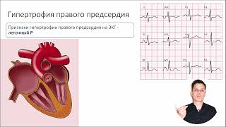 ЭКГ за 100 минут №6: Гипертрофия сердца на ЭКГ