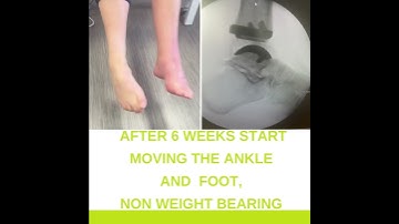 Recovery After Ankle Joint Replacement Surgery