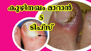 കുഴിനഖം മാറാൻ 5 ടിപ്സ് | toenail fungus | kuzhi nagam treatment | malayalam health tips