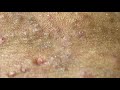 Many Blackheads Removal | Satisfying Pimple Popping Videos | ニキビ 角栓