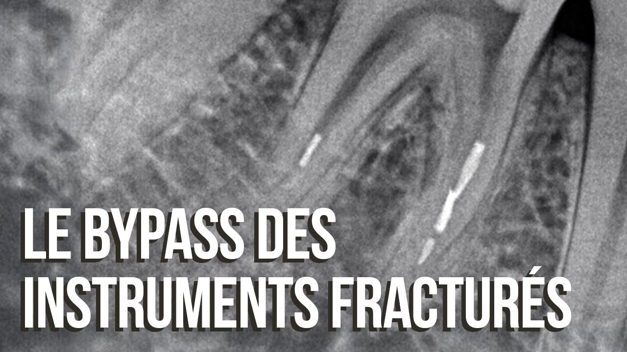 Bypass des instruments fracturés - Benjamin Boublil