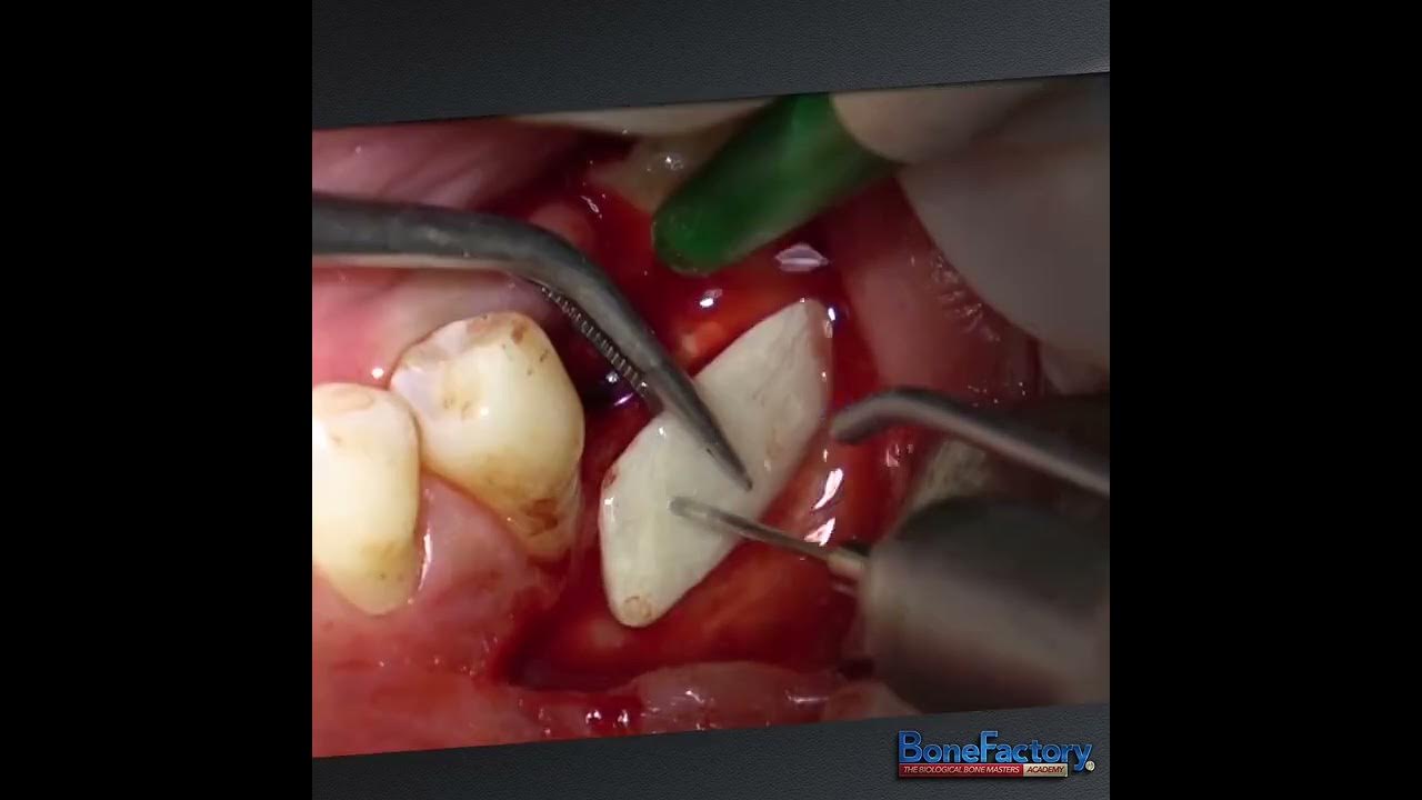 KHOURY TECHNIQUE from his former student Horizontal Bone Augmentation