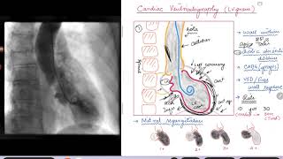 Cardiac Ventriculography (Left Ventriculogram)