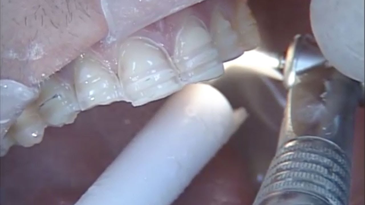 Pre Preparation Contouring To Achieve Ideal Archform With IPS Empress® Veneers