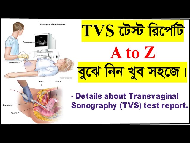 TVS টেস্ট রির্পোট বুঝার সহজ উপায়। How to read Transvaginal ultrasound or TVS test report? TVS test class=