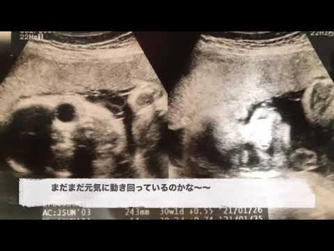 エコー記録（妊娠29週）