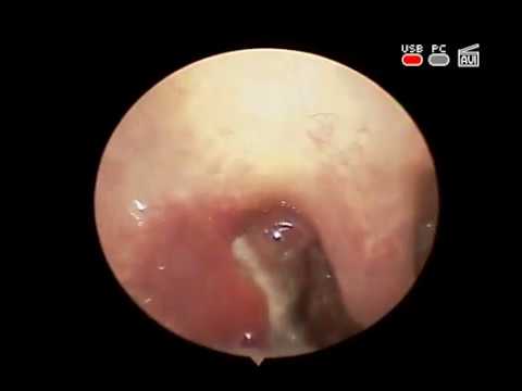 #Гнойная #ангина воспаление #Миндалин, глотки