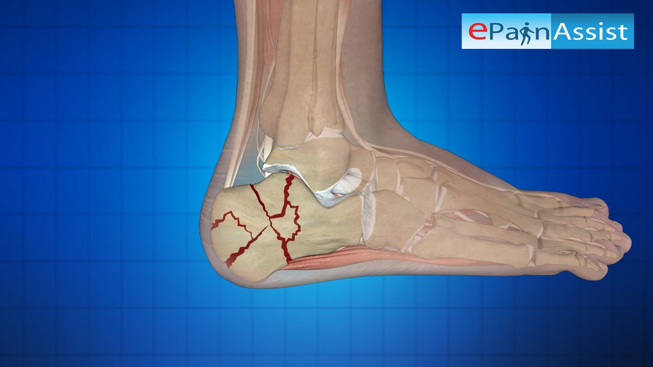 Examine These Tips For Identifying And Treating Heel Fractures