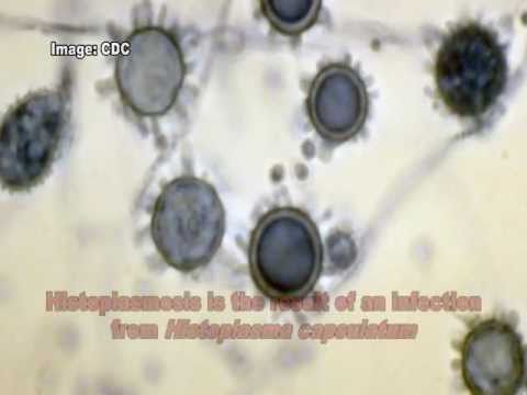 Histoplasma capsulatum & Histoplasmosis