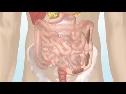 Vidéo: Ballonnements Abdominaux Et Maux De Dos: Causes, Symptômes D'urgence, Etc