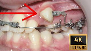 Smile MAKEOVER ! Braces time lapse.