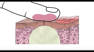 Using glycolic acid to help clear acne - Acne.org