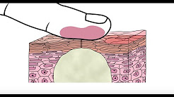 Using glycolic acid to help clear acne - Acne.org