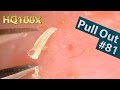 #81 Pull Out Blackheads Close up 100X - Blackheads Removal | ピンセットで角栓を抜く