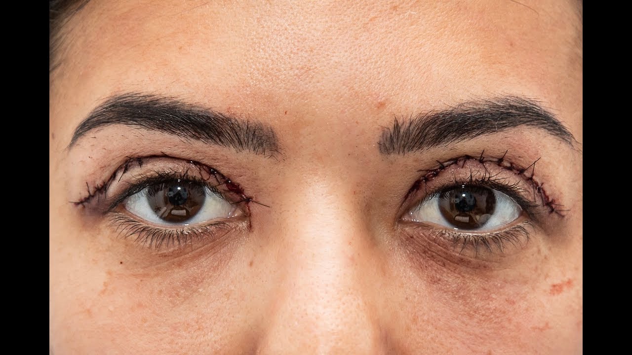 Cuanto cuesta la blefaroplastia