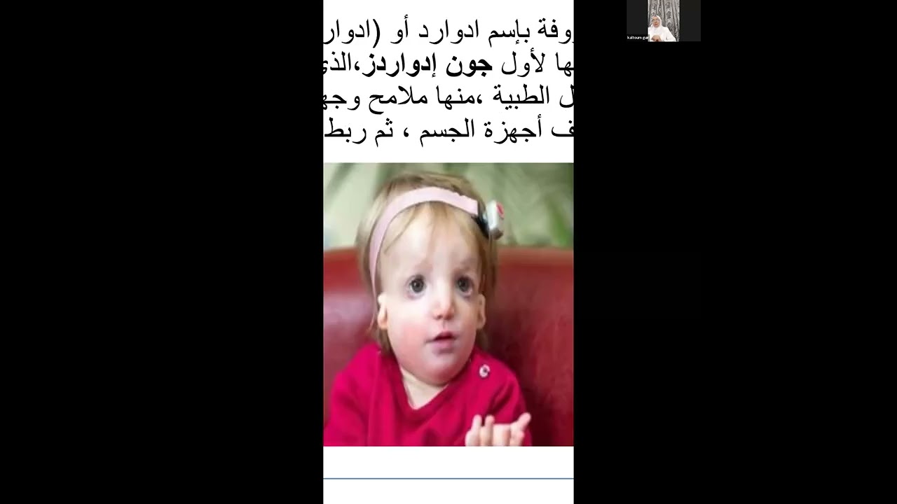 متلازمة ادوارد