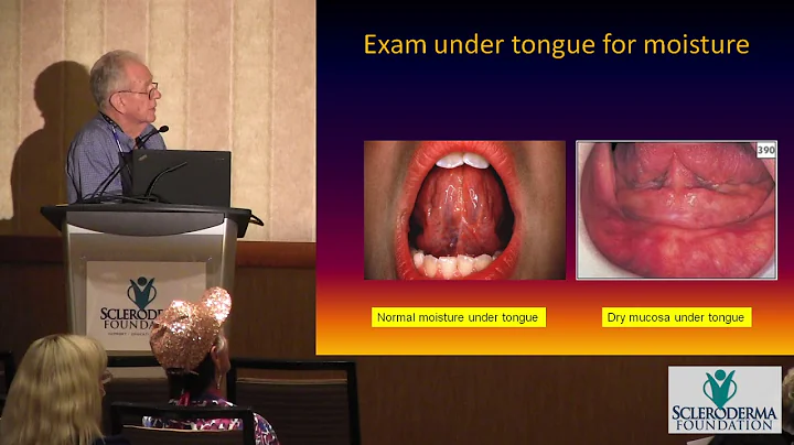 Dry Eyes, Dry Mouth (Sicca Syndrome versus Sjogren...