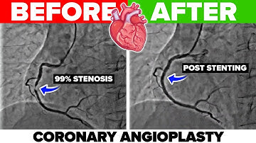 Coronary Angiography & Angioplasty for Myocardial Infraction: Doctor Explains