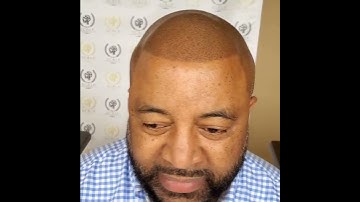 Scalp Micropigmentation After 2nd Session