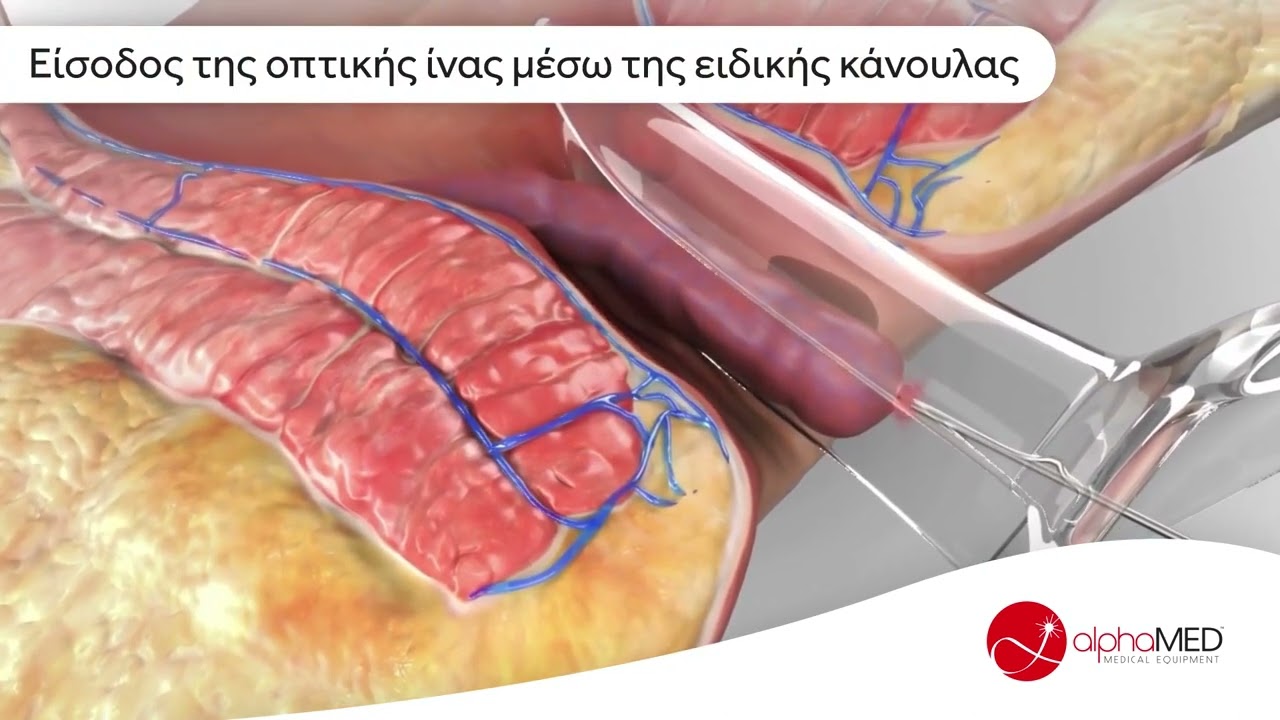 Ελάχιστα Επεμβατική LASER θεραπεία Αιμορροΐδων