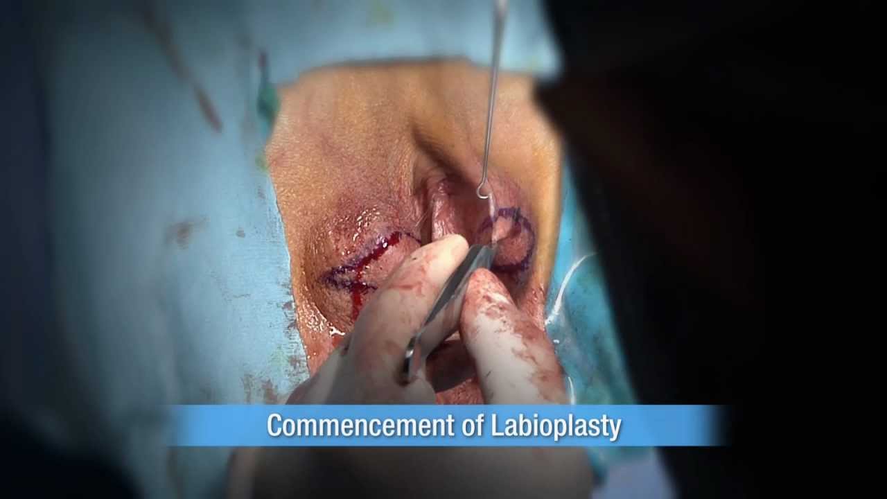 Labial Plastic Surgery 