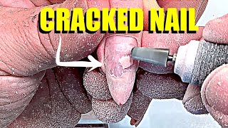 CRACKED NAIL WITH THE LIFTING IN THE MIDDLE WAS EASY INFILLED BY RUSSIAN PRO screenshot 1