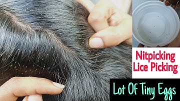 OMG! | Tons of NitPicking / Lice Picking | Plenty of Tiny Eggs with Real Sounds Part #2