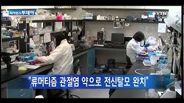 "류머티즘 관절염 약으로 전신탈모 완치" / YTN 사이언스